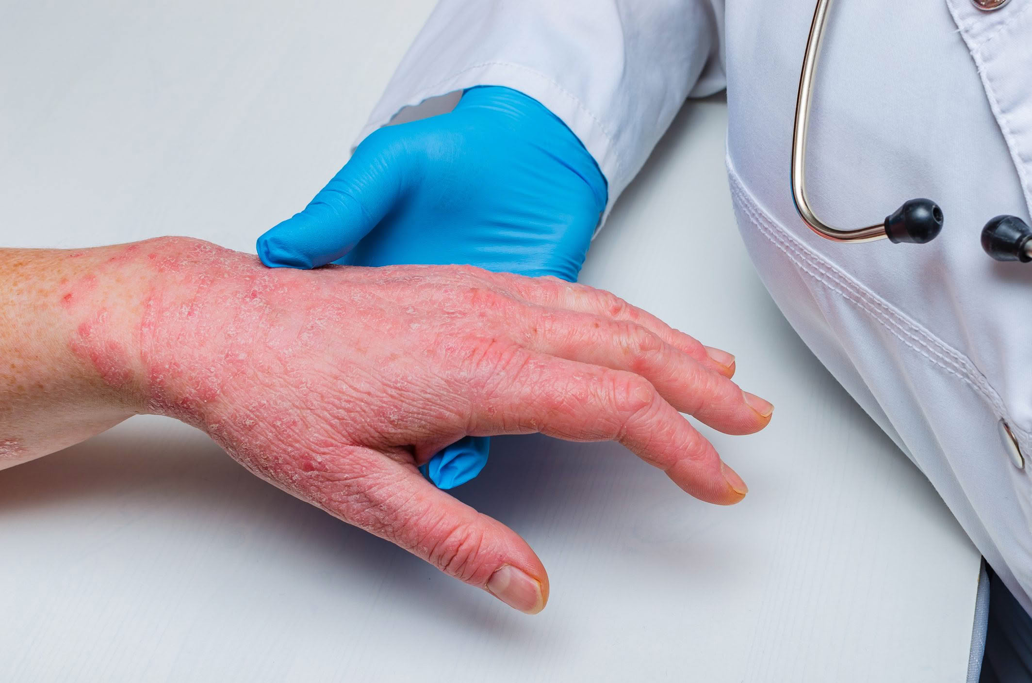 Cryotherapy for eczema & psoriasis